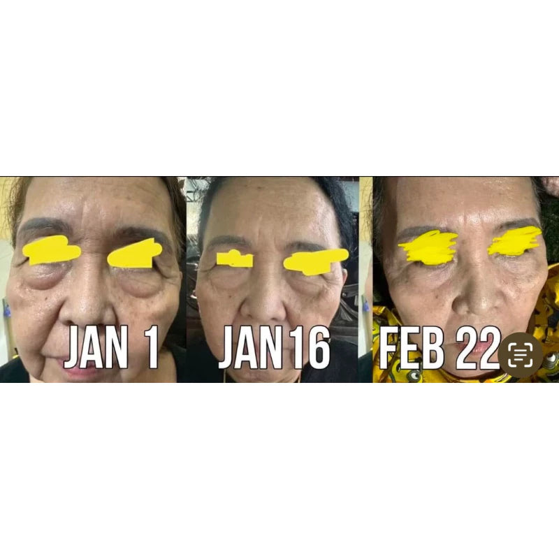 Eye Collagen Botox with Massager | Cinema SkinFX Philippines